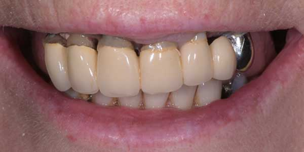 Cas cliniques - Parodontologie - Dentiste à Caen