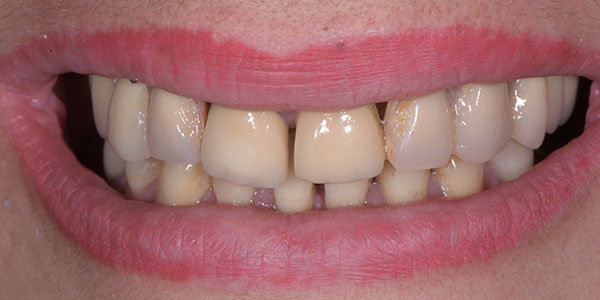 Cas cliniques - Parodontologie - Dentiste à Caen