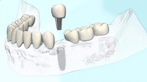 L'implant unitaire mandibulaire, prothèse transvissée