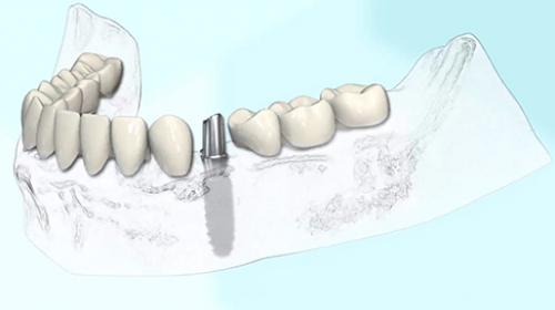L'implant unitaire mandibulaire prothèse scellée