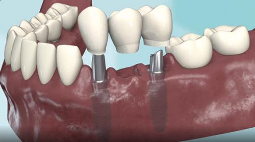 Trois dents scellées sur deux implants