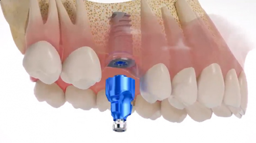 Remplacement d’une dent par un implant